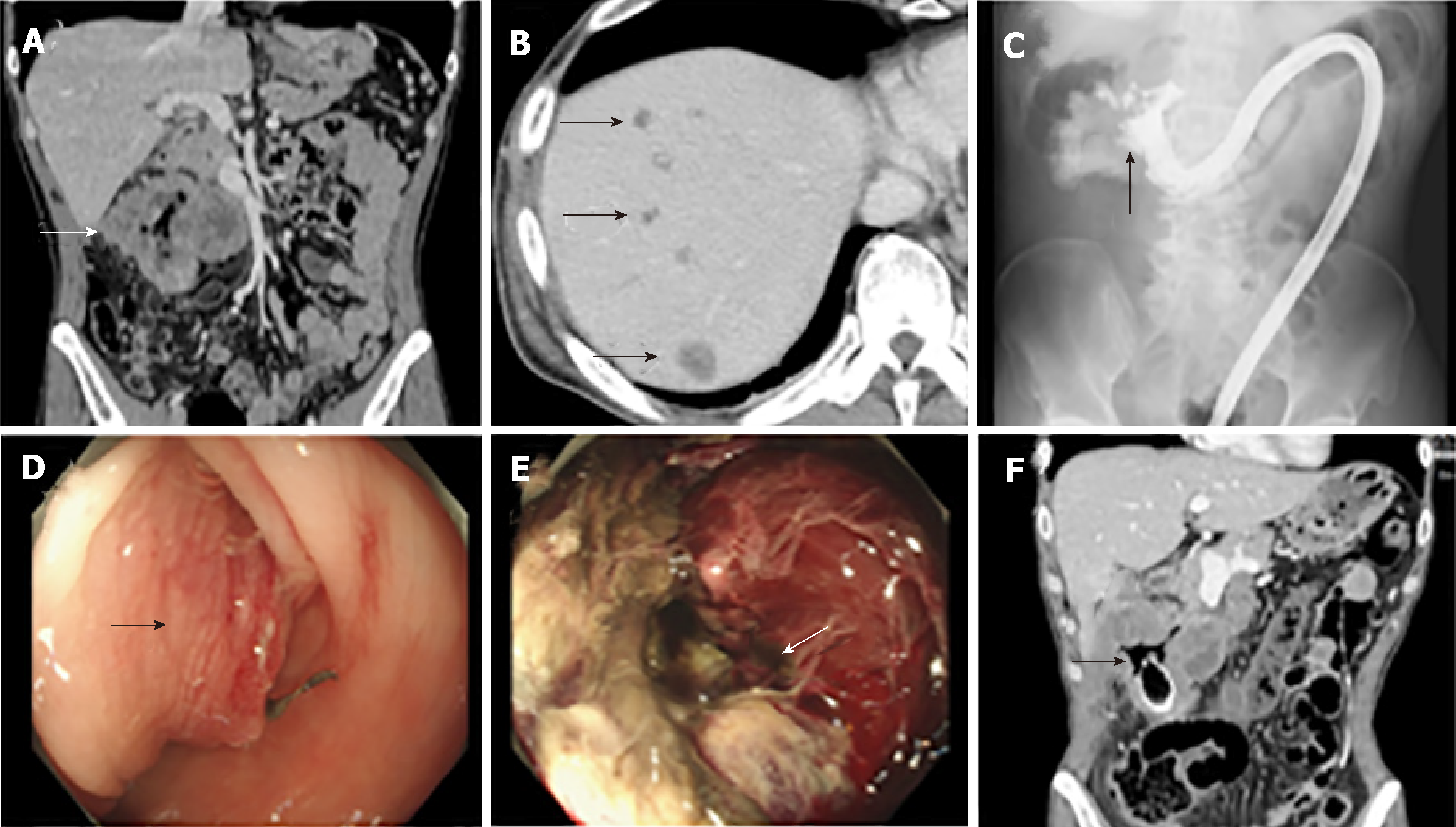 Case of neuroendocrine recto sigmoid carcinoma